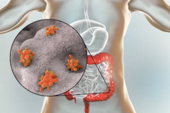 3 lưu ý khi lựa chọn sản phẩm điều trị viêm đại tràng